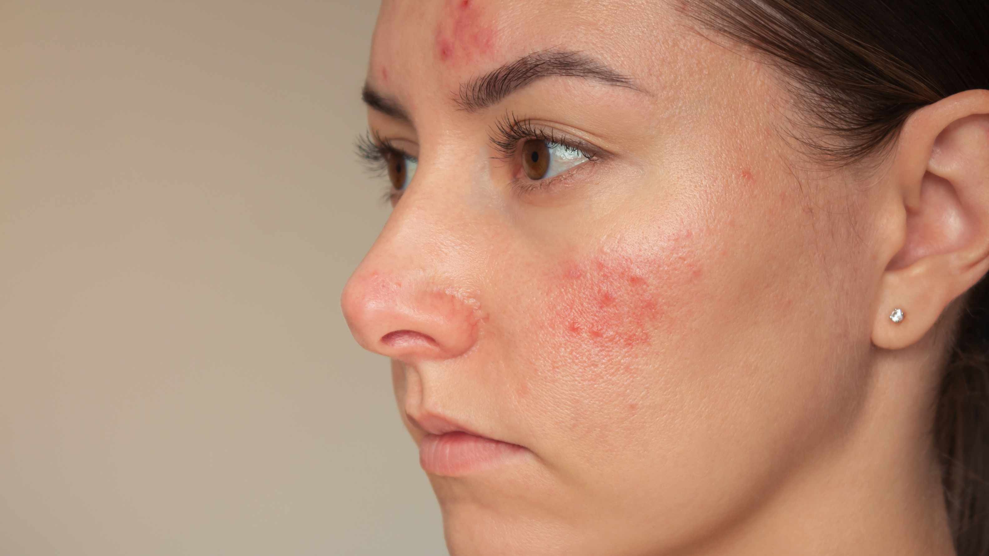 Learn how to treat chemical burn on face