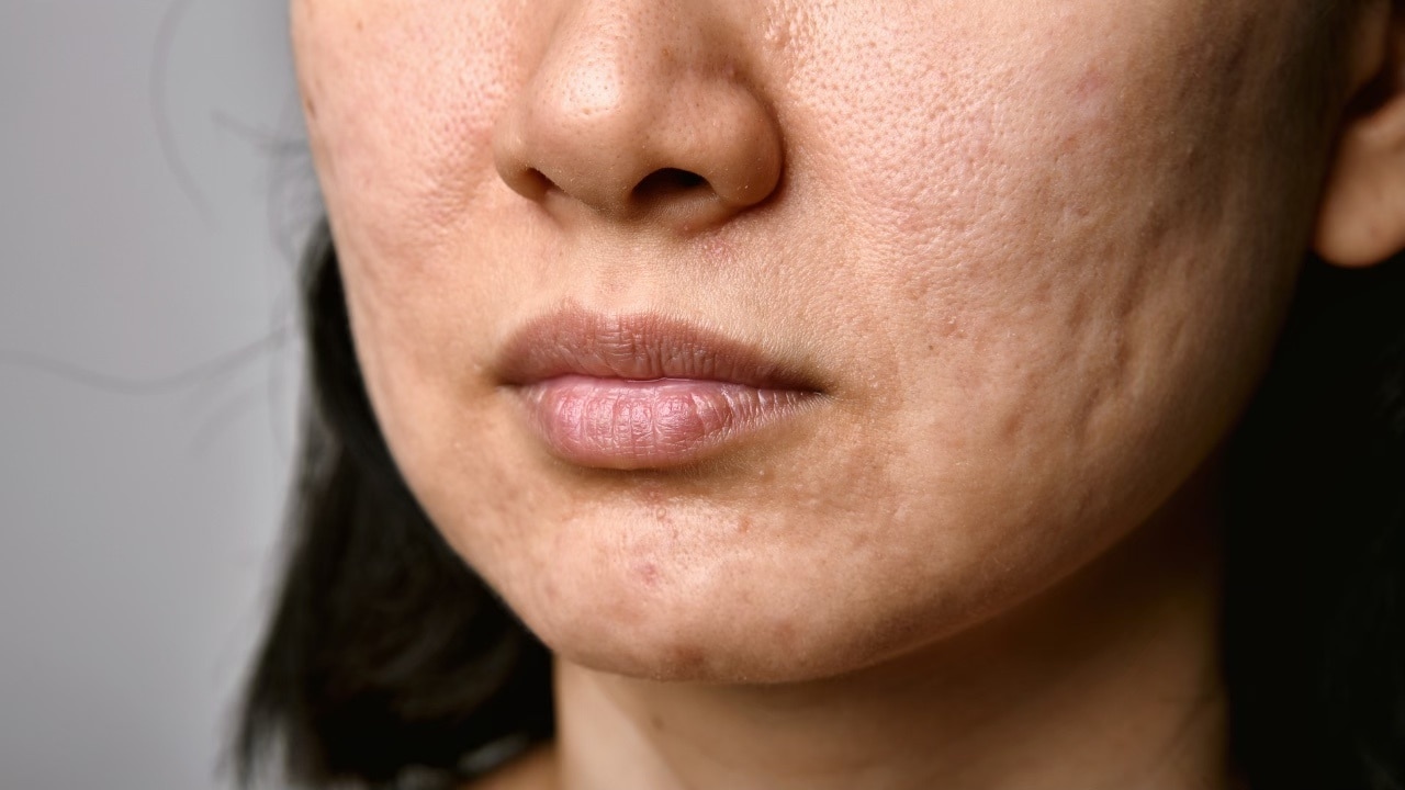 Lightens scars and marks