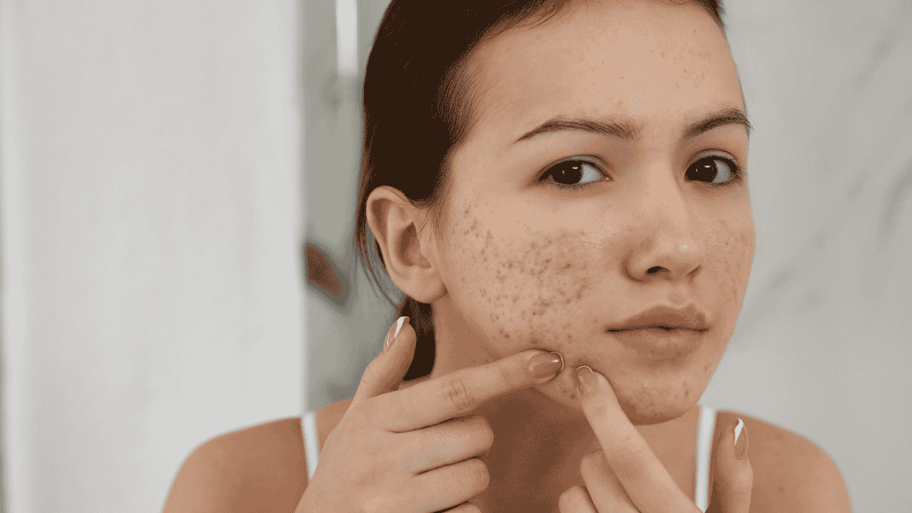 Prevents Acne, Pimples and Breakouts