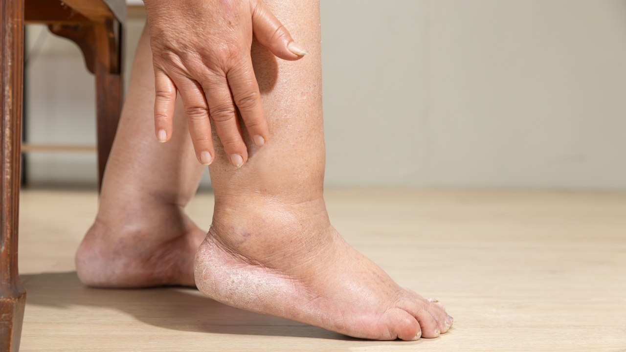 8. Reduces edema effect