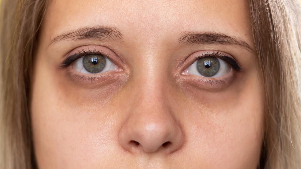 Reduces dark circles and puffy eyes