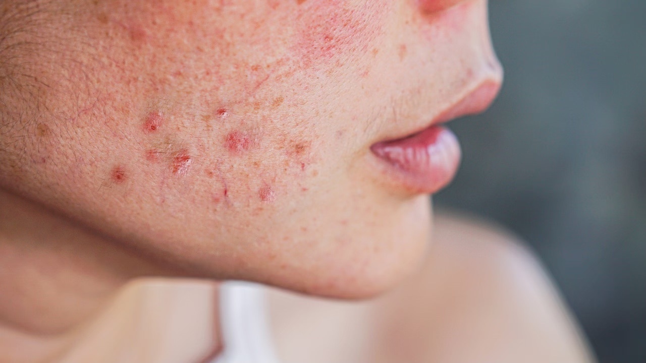 Soothes inflammation