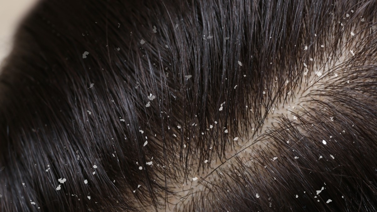 Tips for Combination Skin Scalp