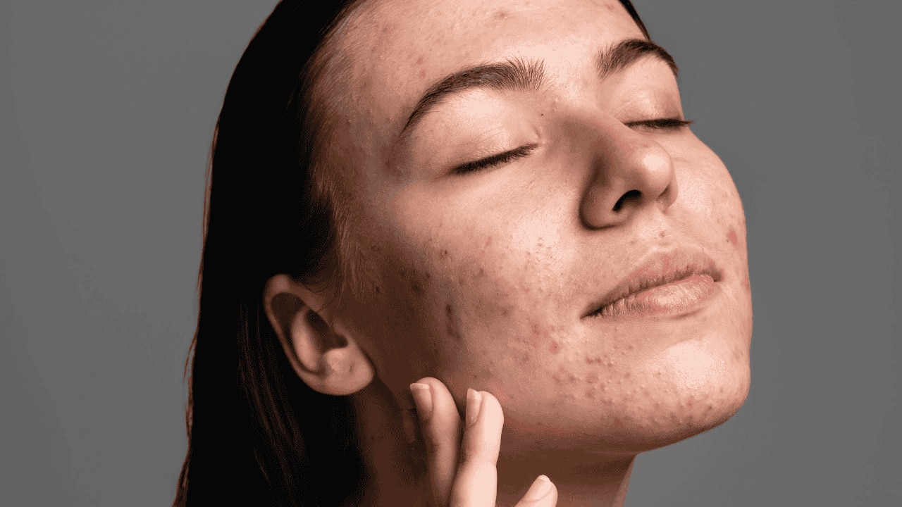 Treats Mild Hyperpigmentation