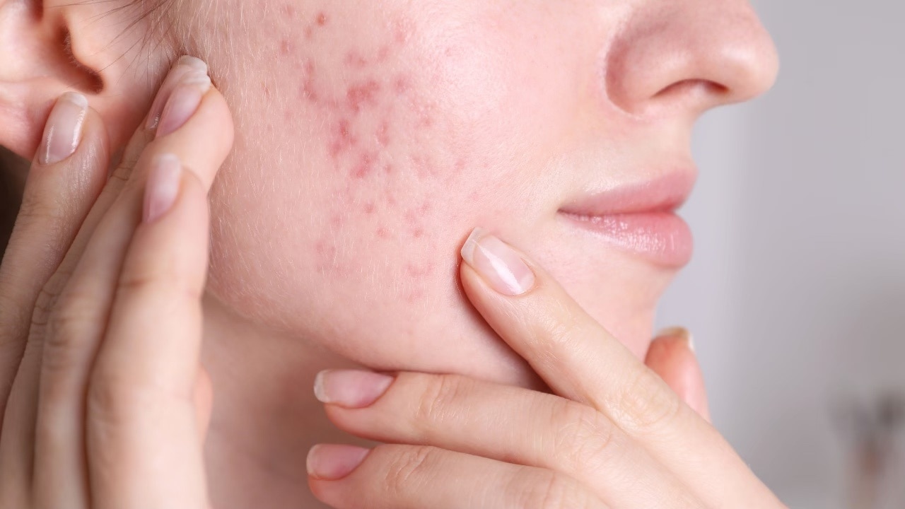 Treats acne
