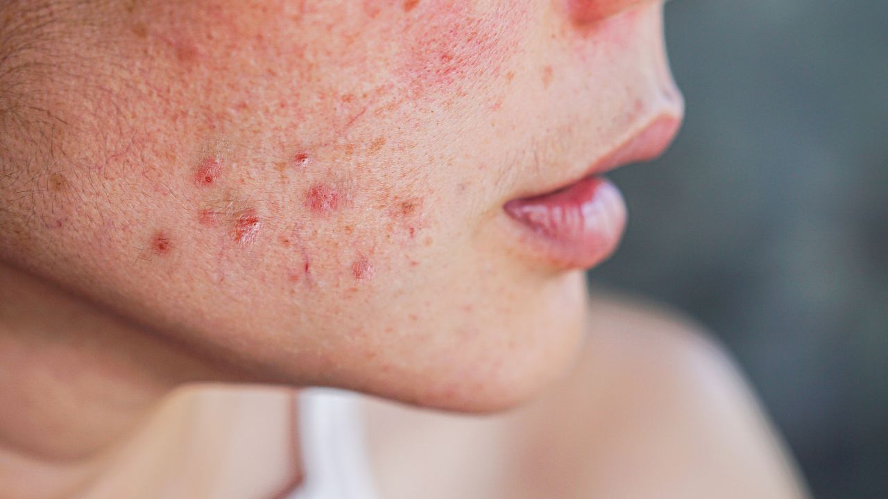 Benefit #1: Treats acne and acne scars