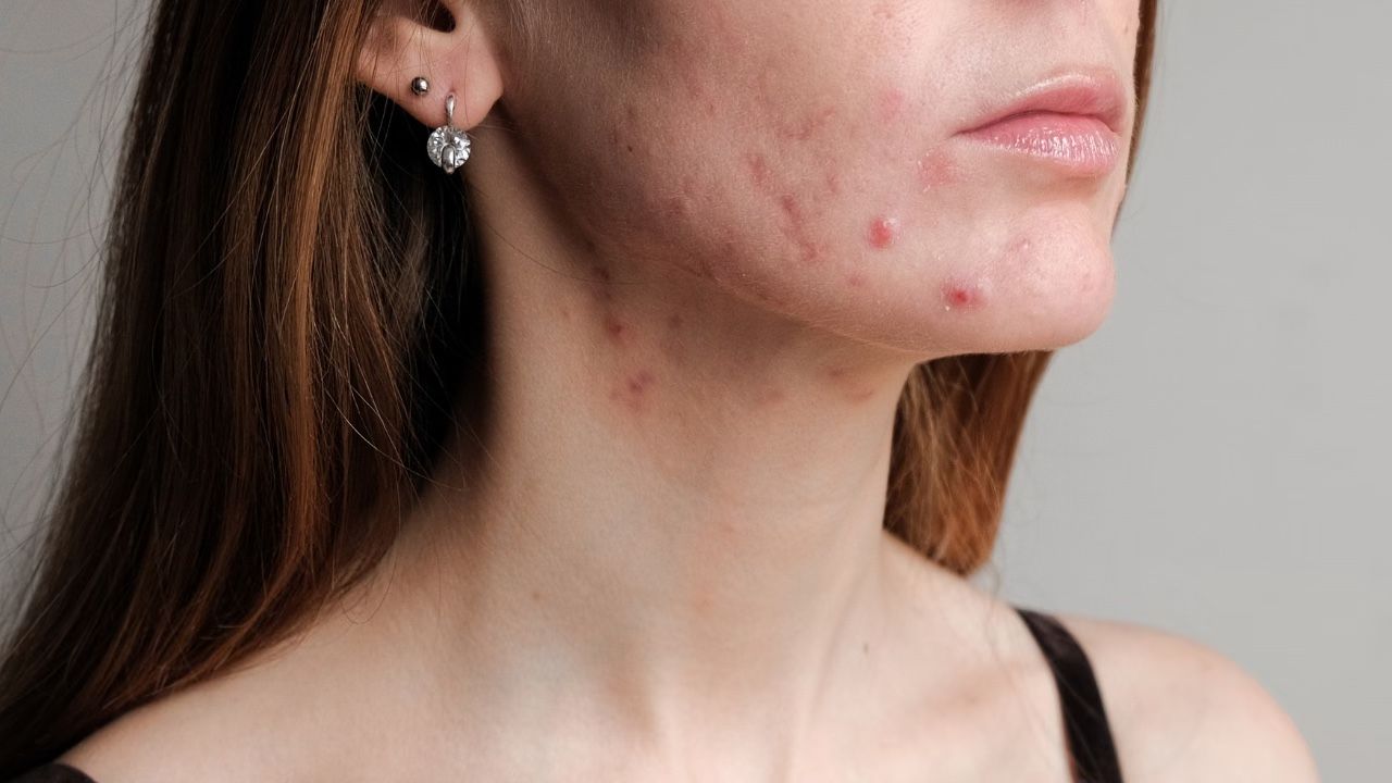 - Treats acne and blemishes