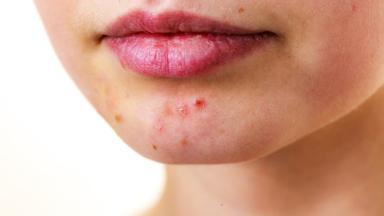 Treats acne