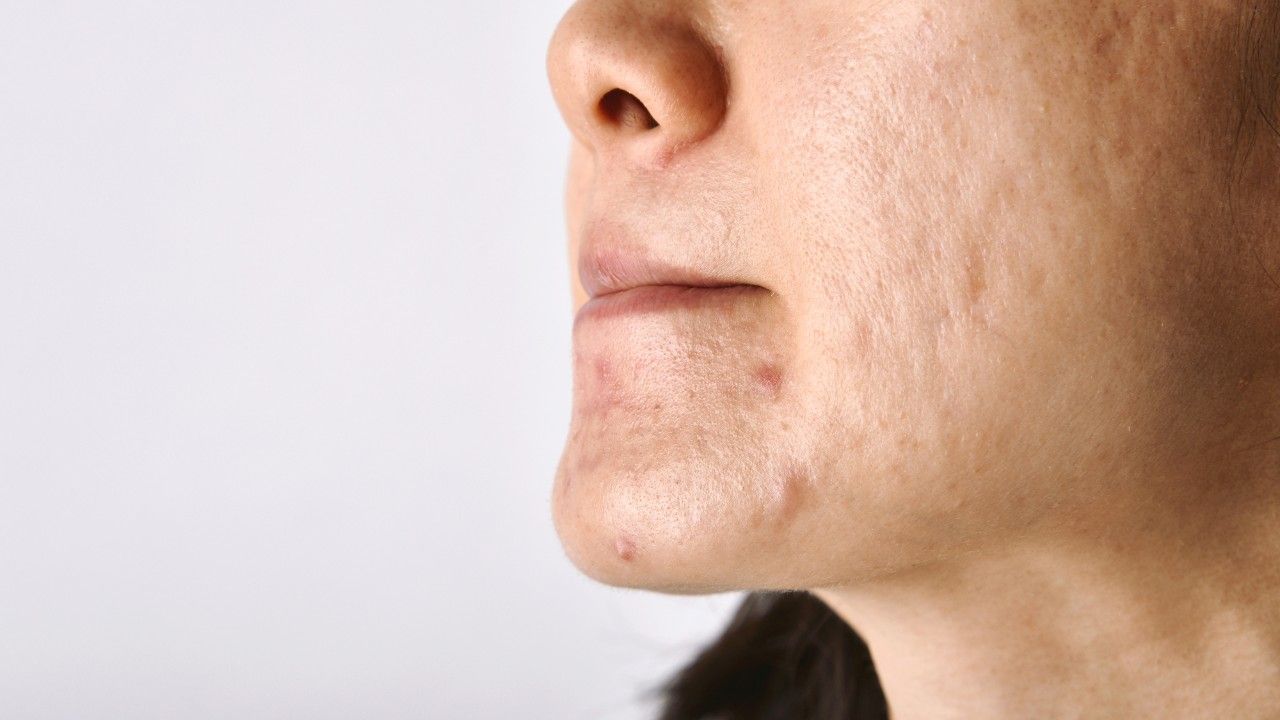Treats acne and blemishes
