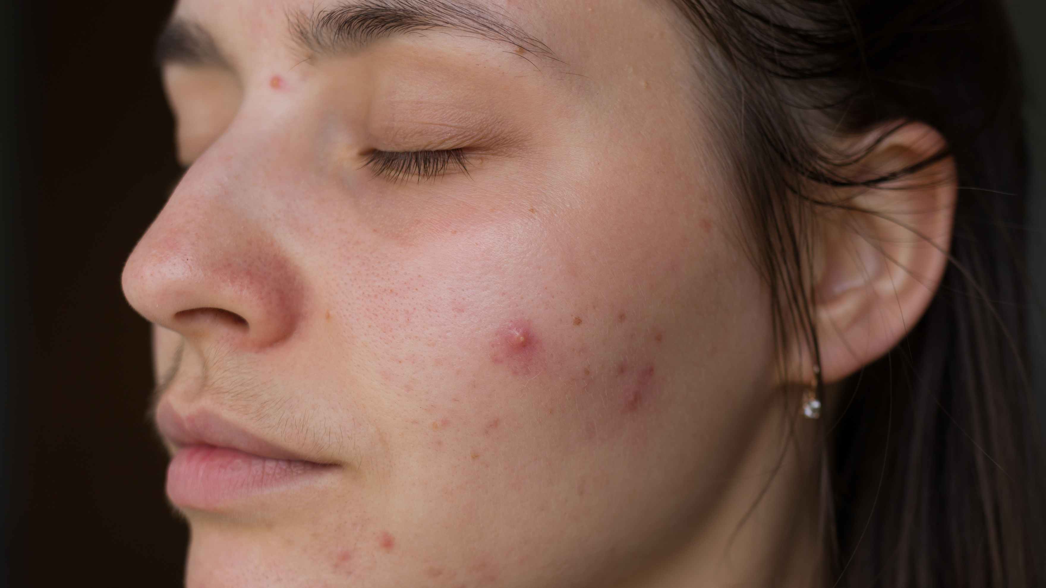 Types of Acne Triggered by Swimming