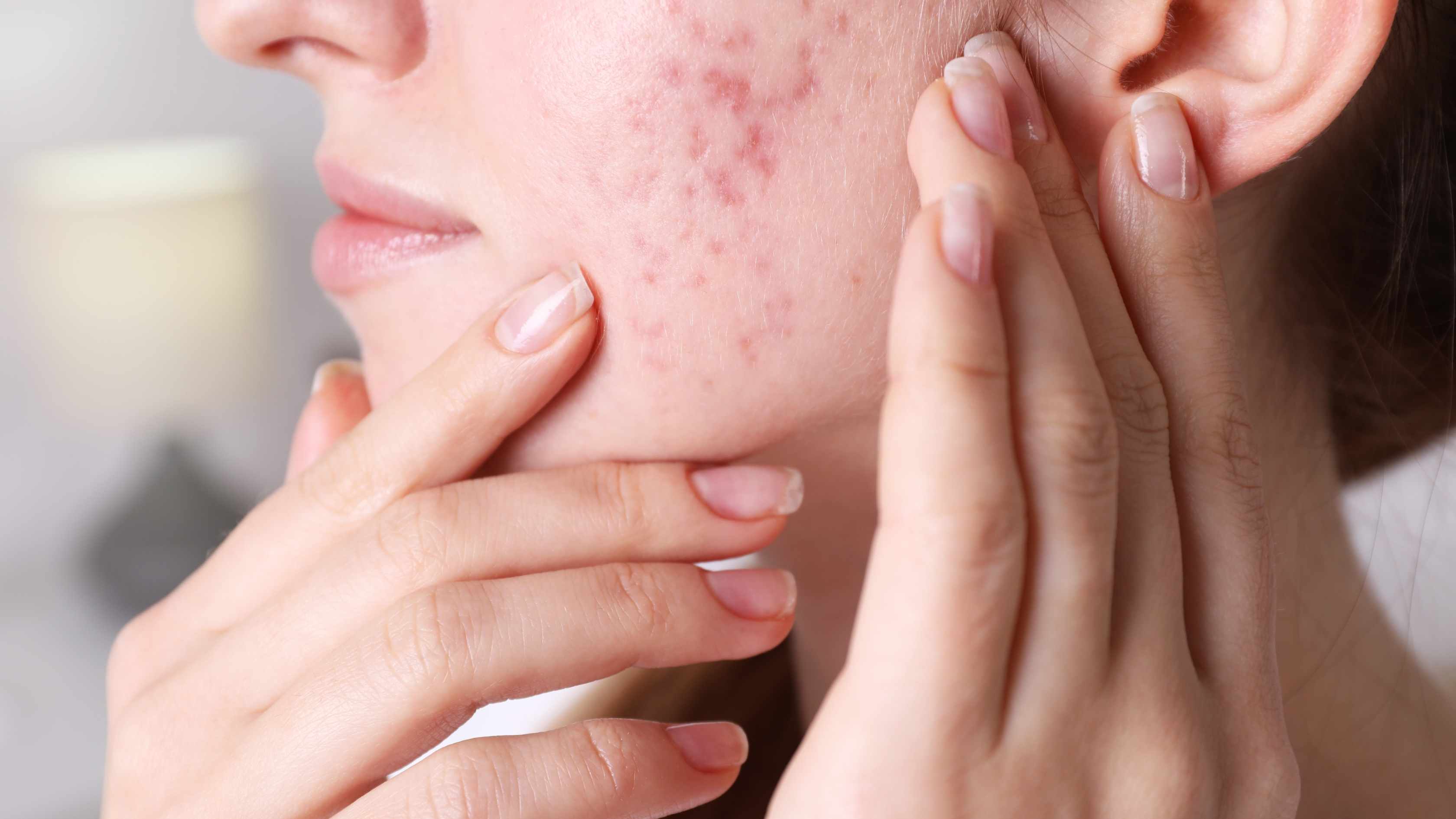 What are scabs on the face and how are they formed?