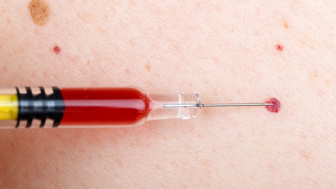 What are some of the treatment options available for cherry angiomas?