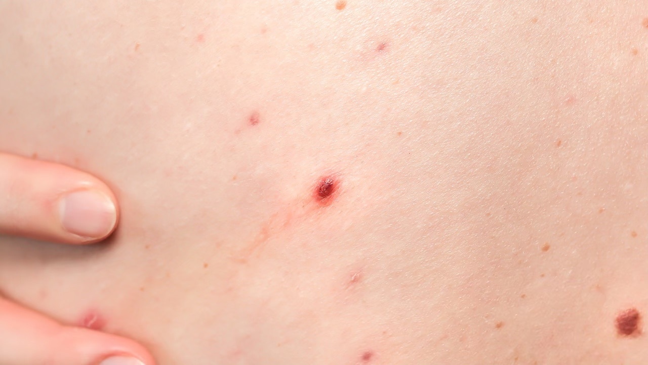 What are the major causes of cherry angiomas?