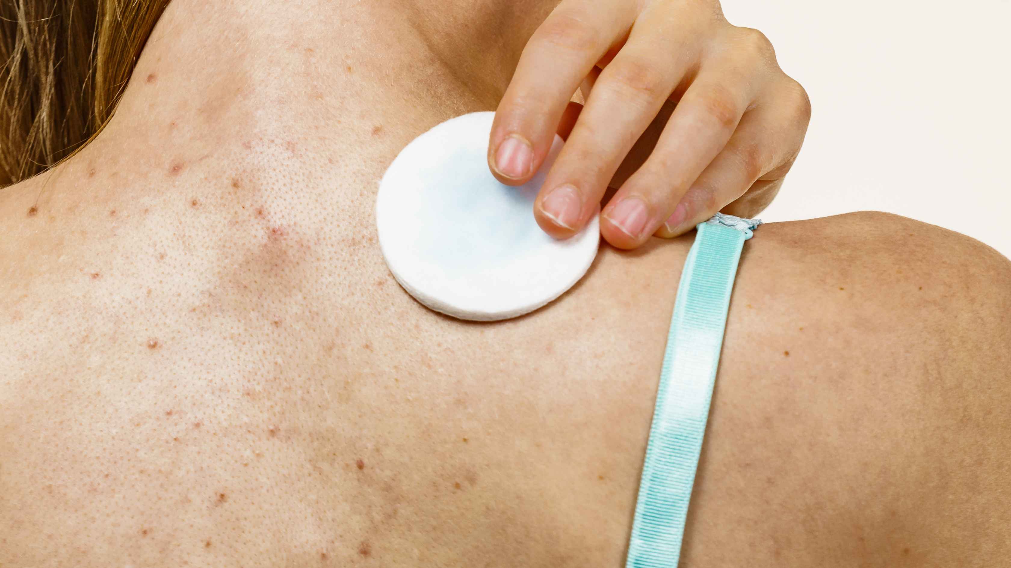 What kinds of acne does benzoyl peroxide help treat?
