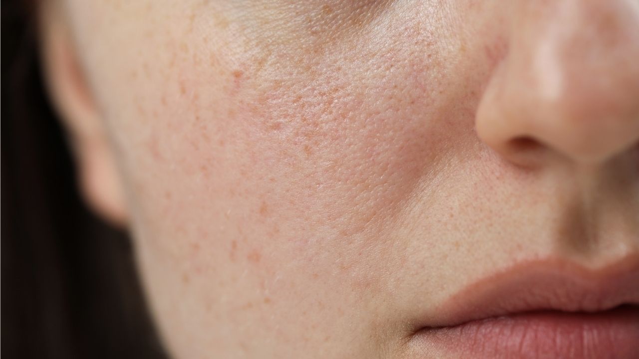 Who Should Avoid Multani Mitti