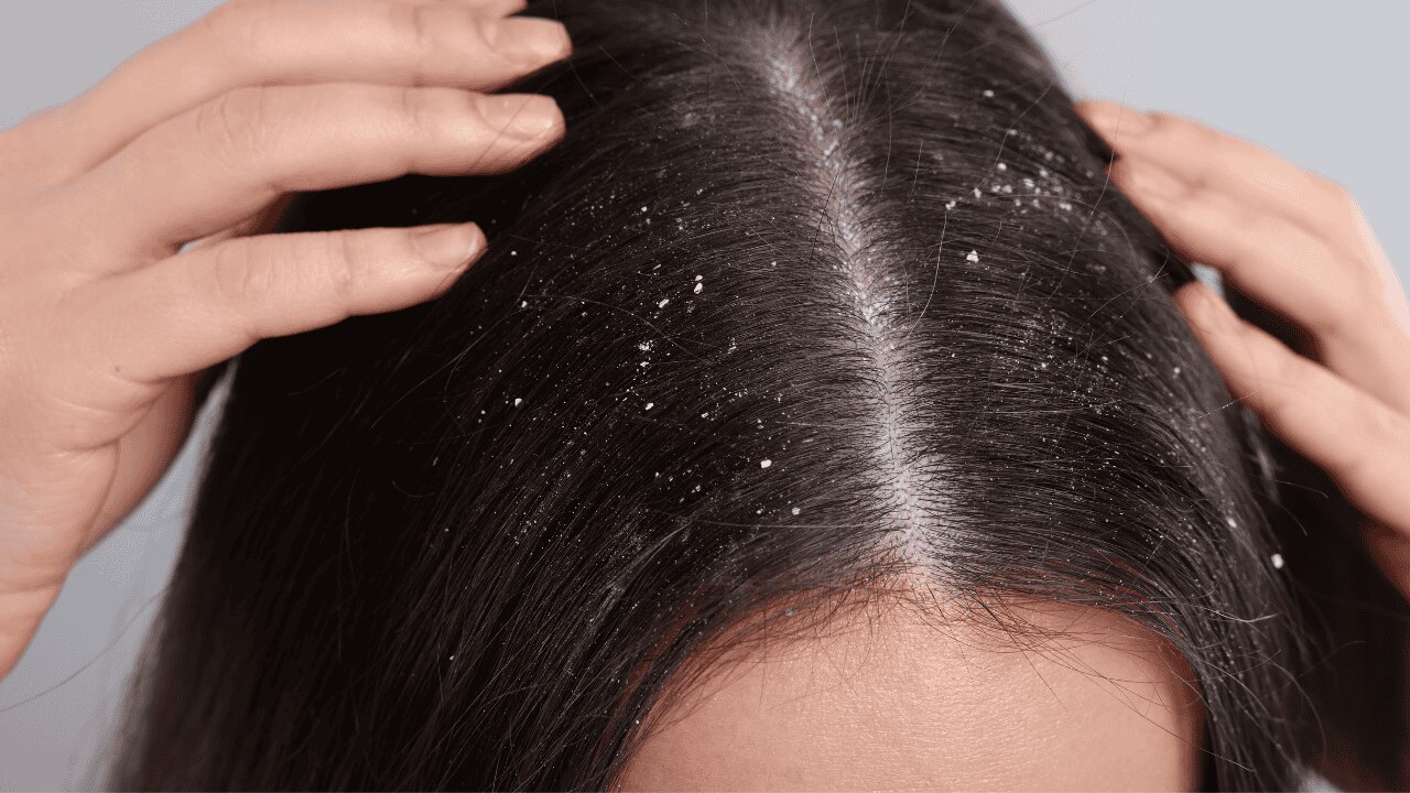 iv) Helps cure dandruff