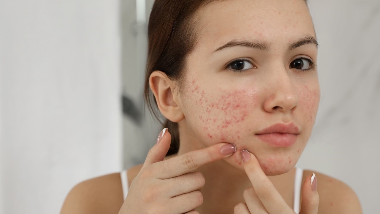 anti-acne face packs