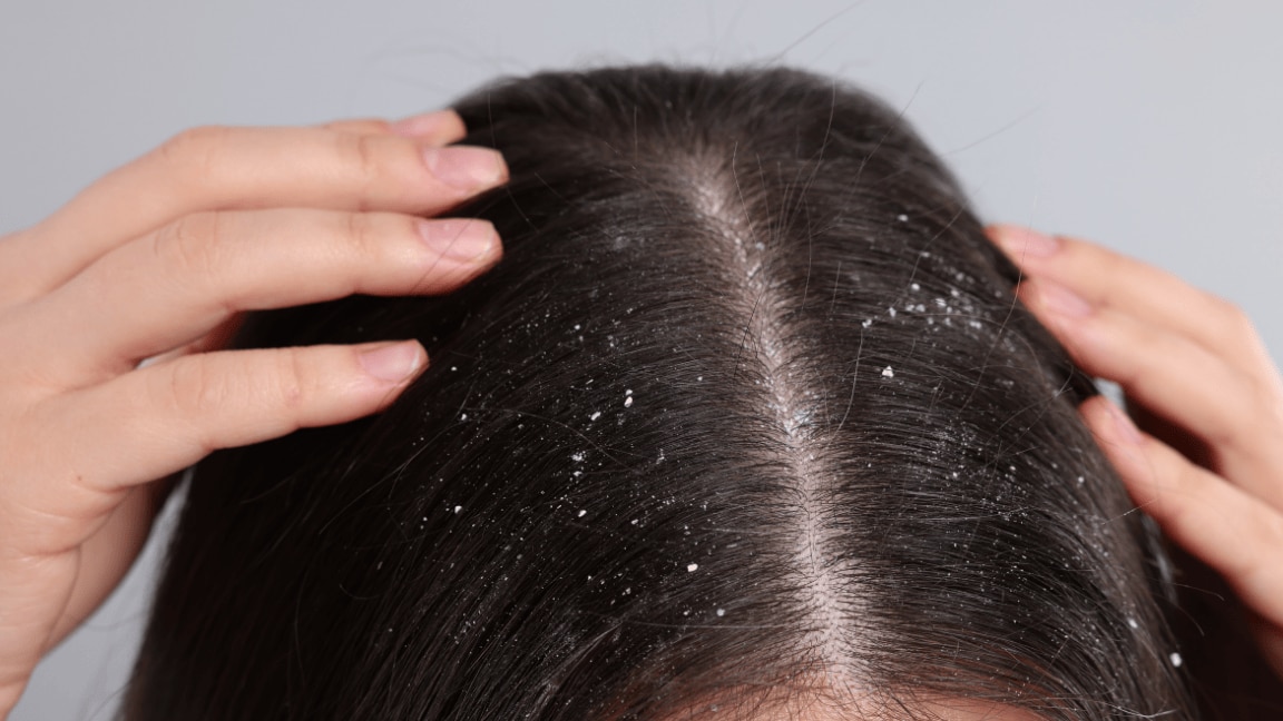 Dandruff Detox: Effective Home Remedies