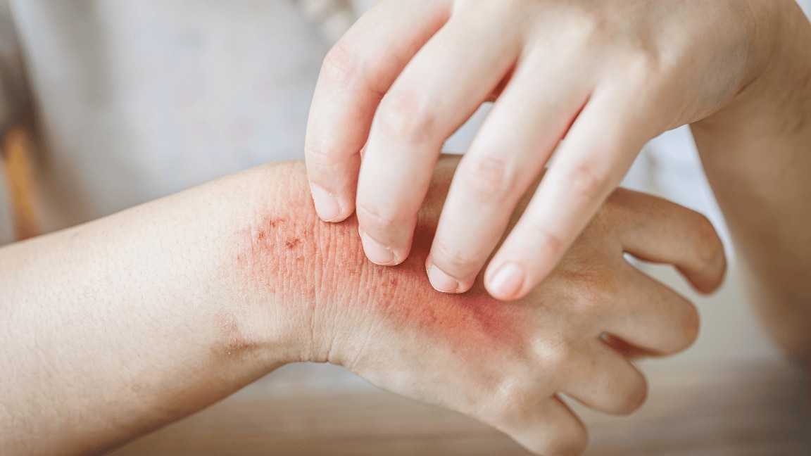 Here Are 9 Home Remedies For Fungal Infection That Will Give You Relief!
