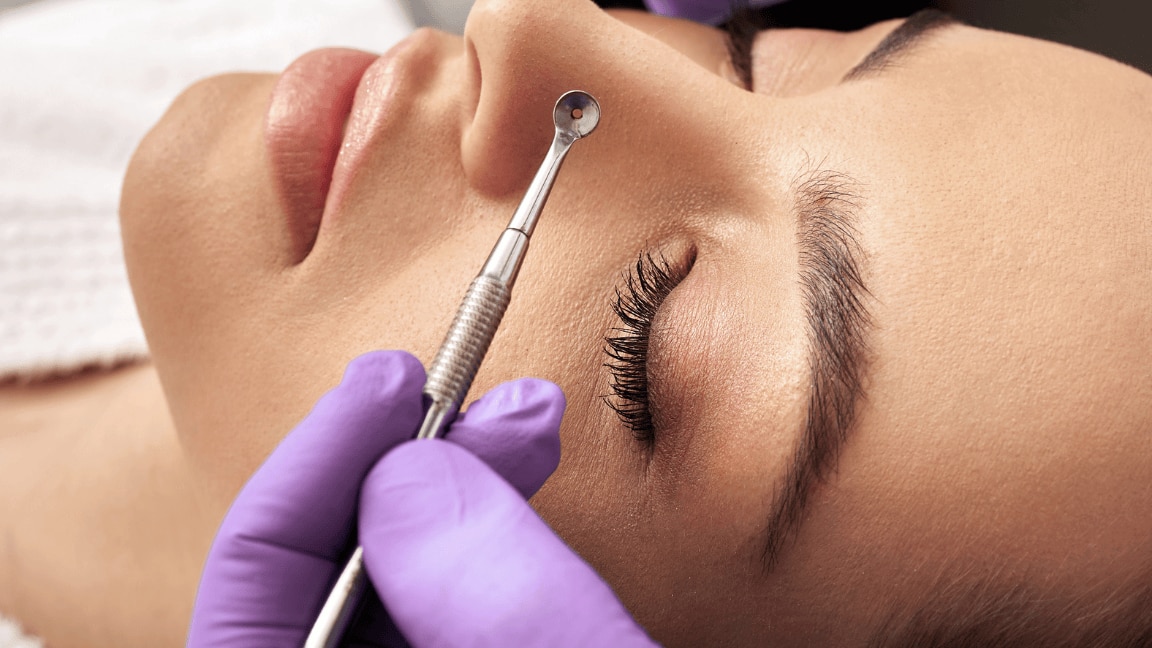 Remove Blackheads From Your Nose With These 7 Top Tips