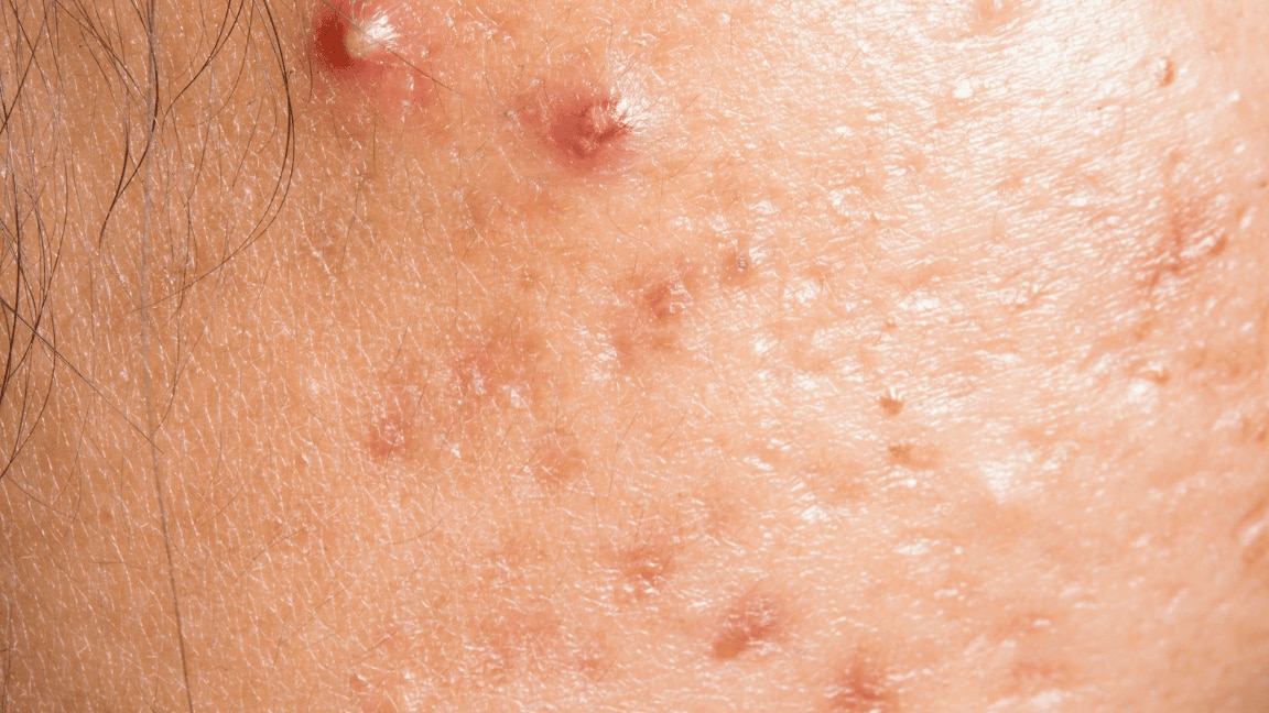 Here’s Everything You Need To Know About Doxycycline For Acne