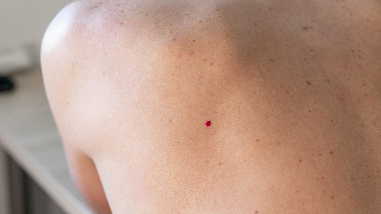 What are the side effects involved with removal of cherry angiomas?