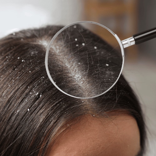 how to get rid of dandruff 