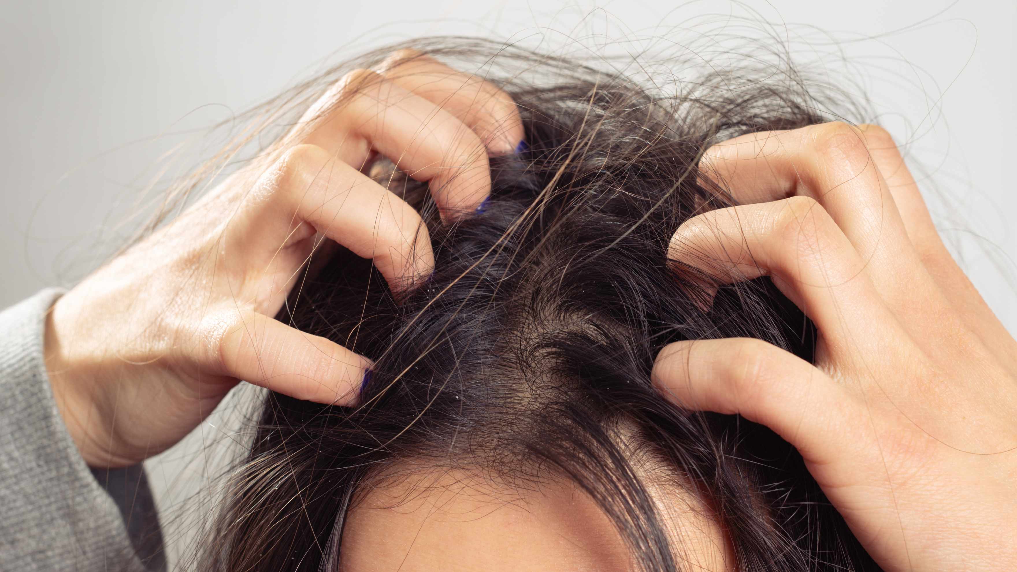 Soothes Dry Scalp and Dandruff Naturally