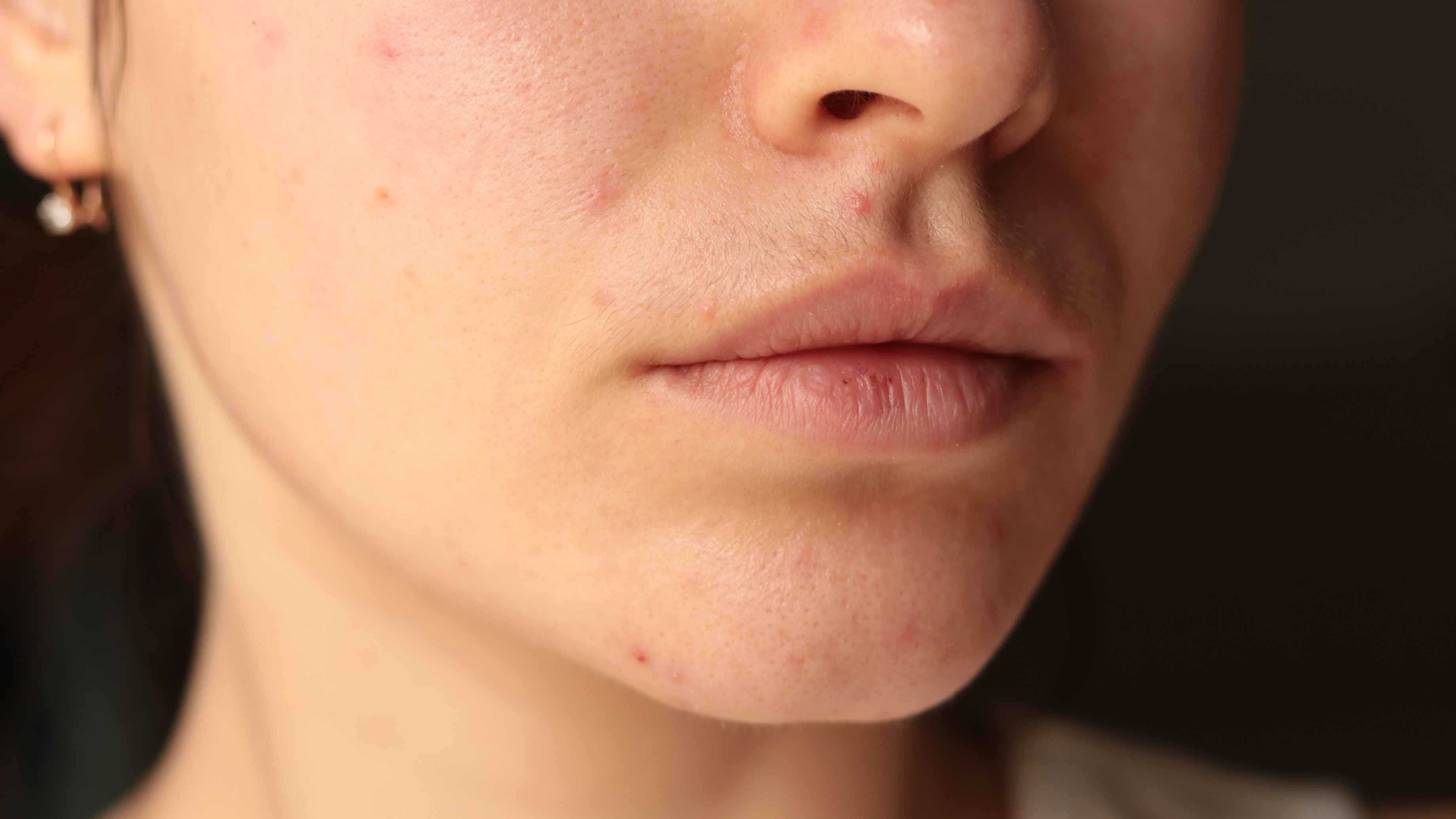 Combination Skin