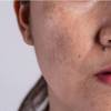 Pigmentation