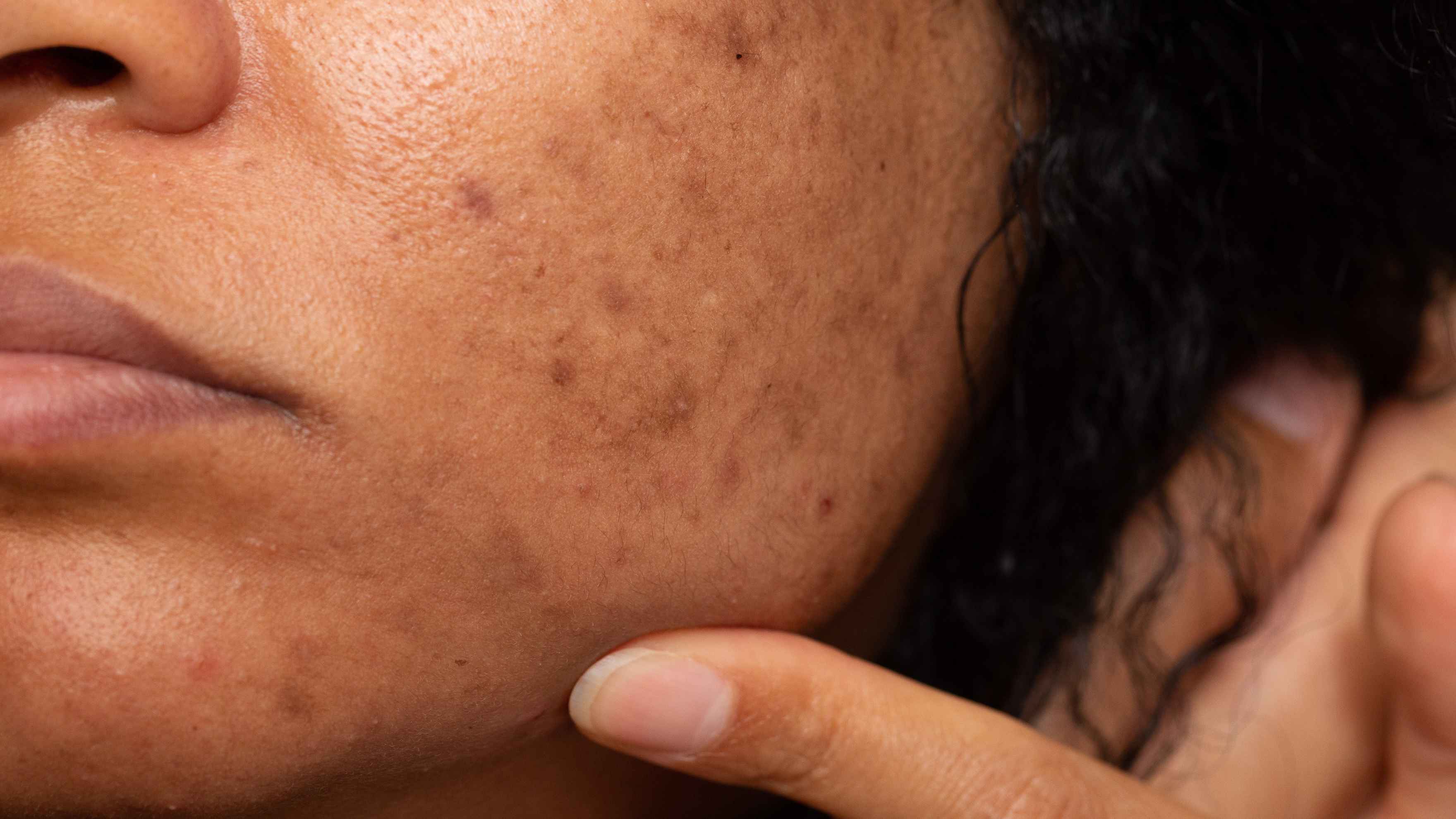 What Is Pigmentation (And Why Does It Happen)