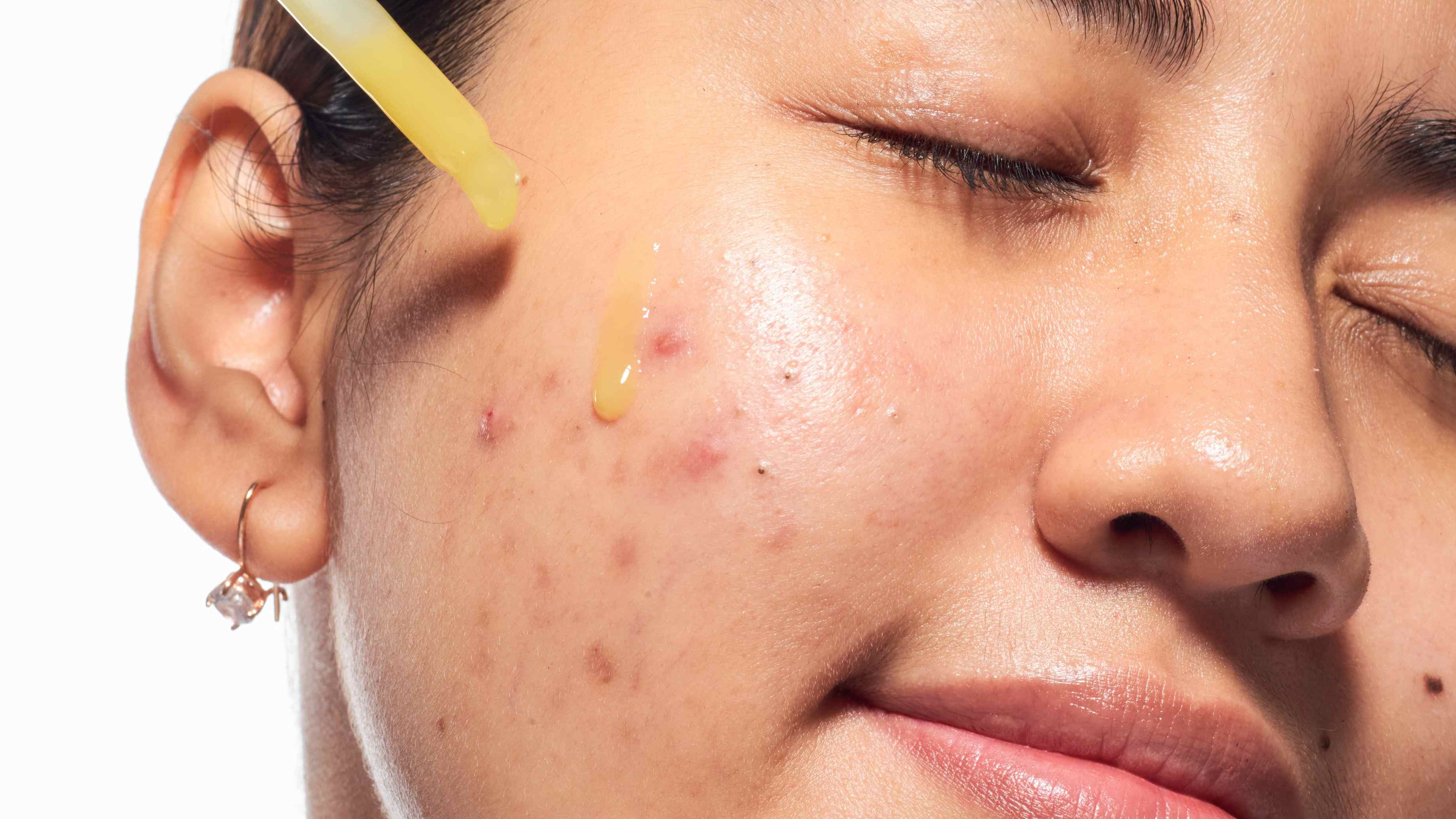 Apply a Spot Treatment Serum