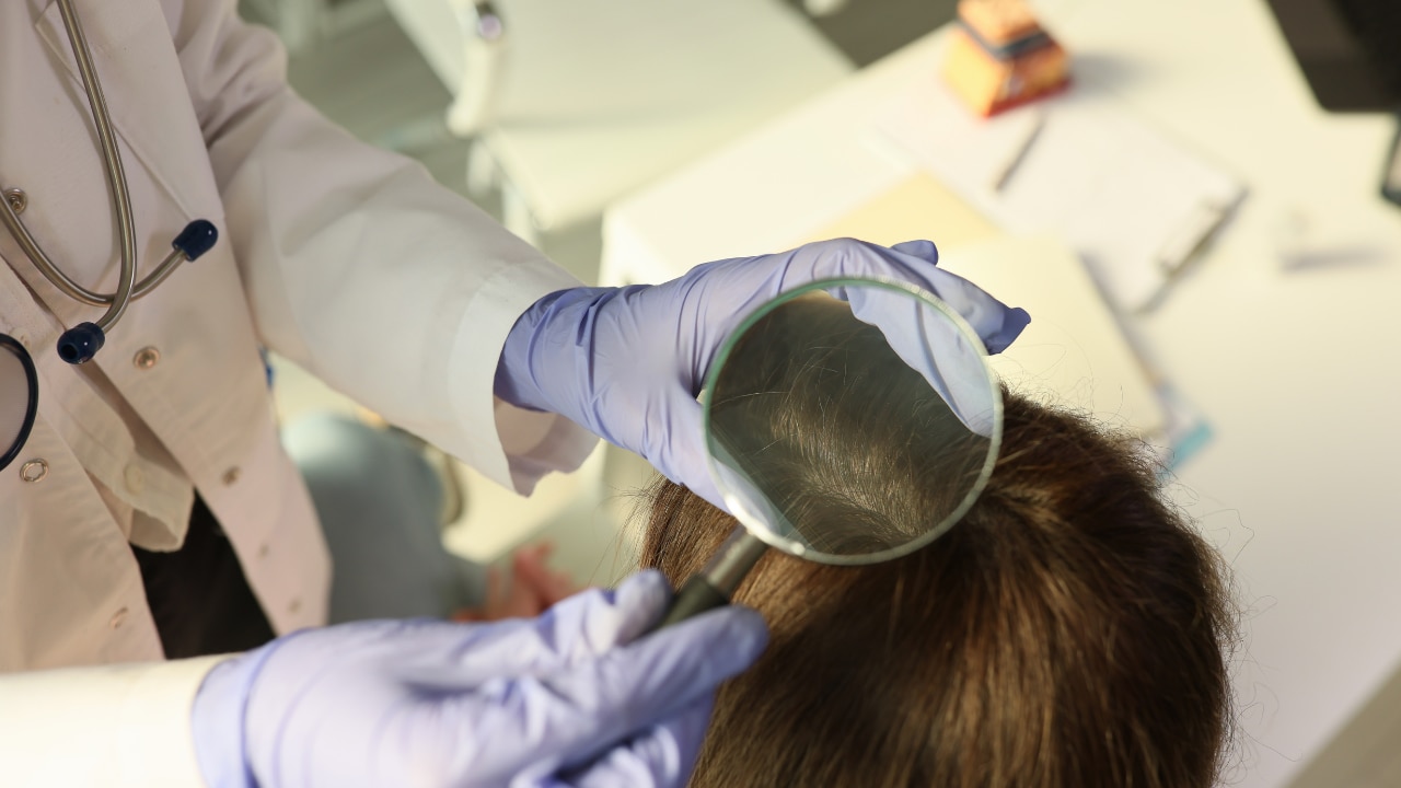 What Causes Dandruff? 