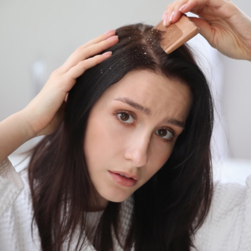 Homemade Hair Masks for Dandruff: Easy DIY Remedies That Actually Work