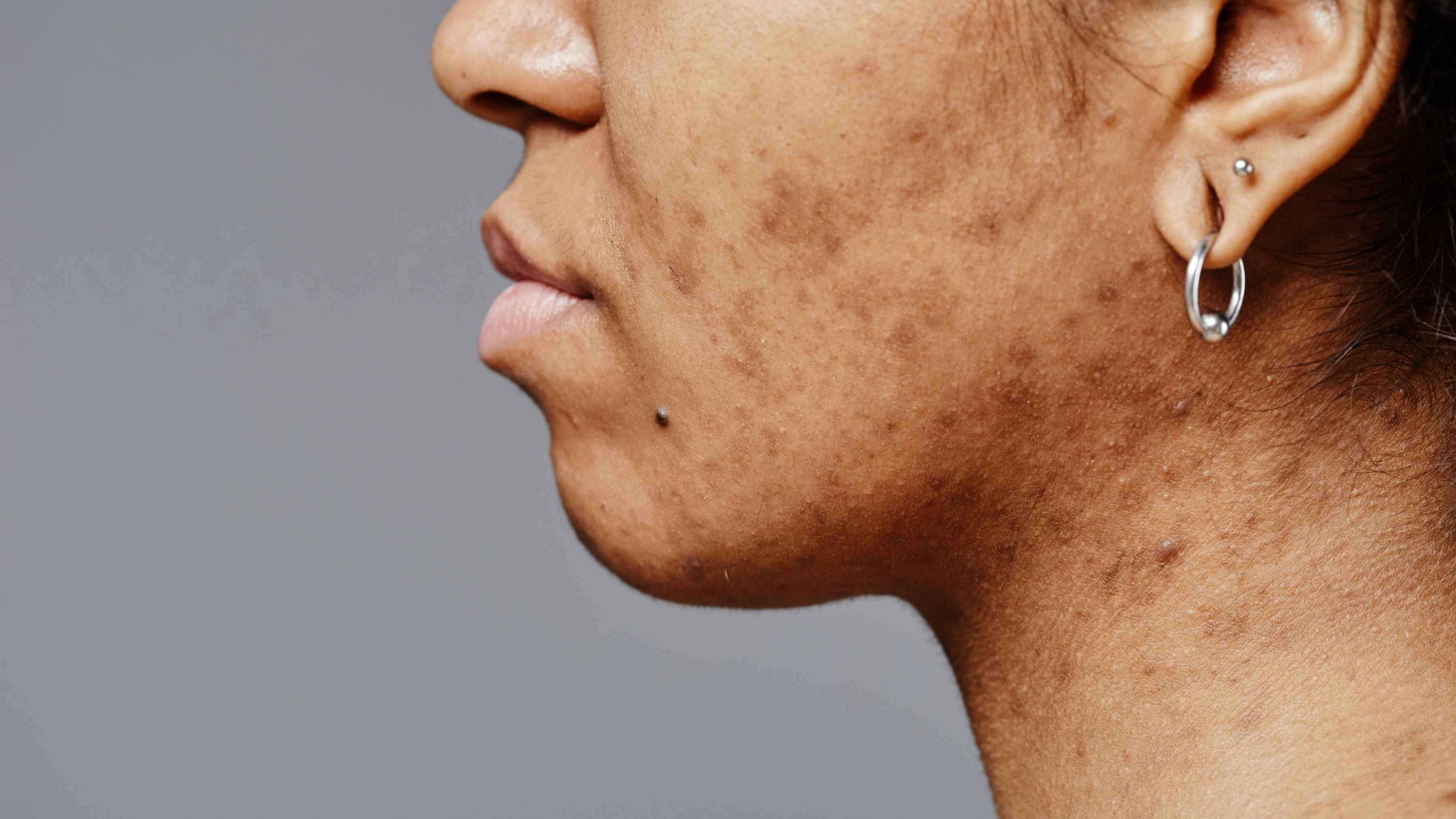 Home Remedies for Pigmentation - Remove Pigmentation from Face Permanently Naturally