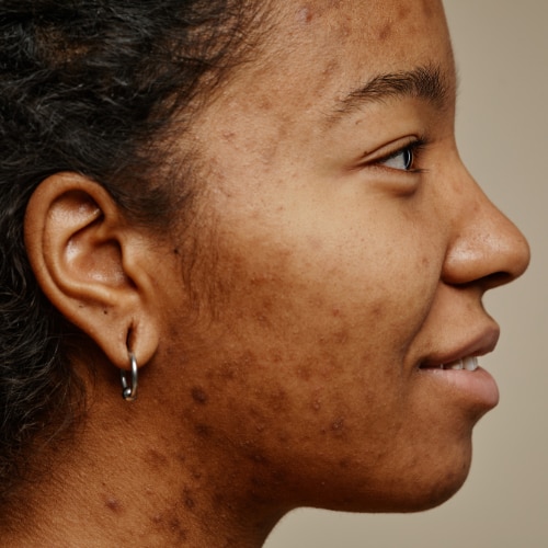 How to Remove Black Spots on Face: Causes, Remedies & Quick Fixes