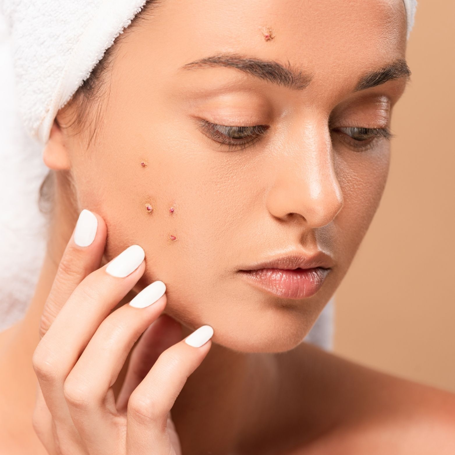 How to Remove Pimples Overnight: Fast, Natural & Dermatologist-Approved Treatments