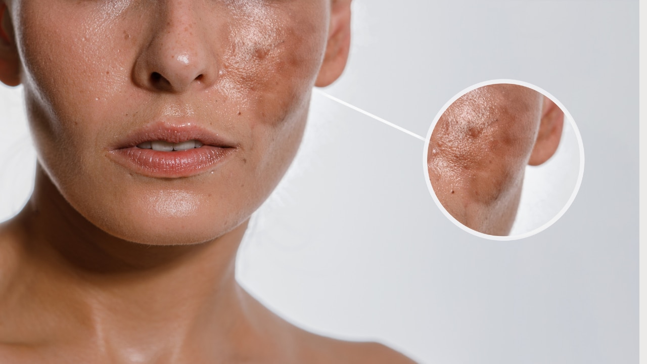 Niacinamide for Pigmentation & Dark Spots
