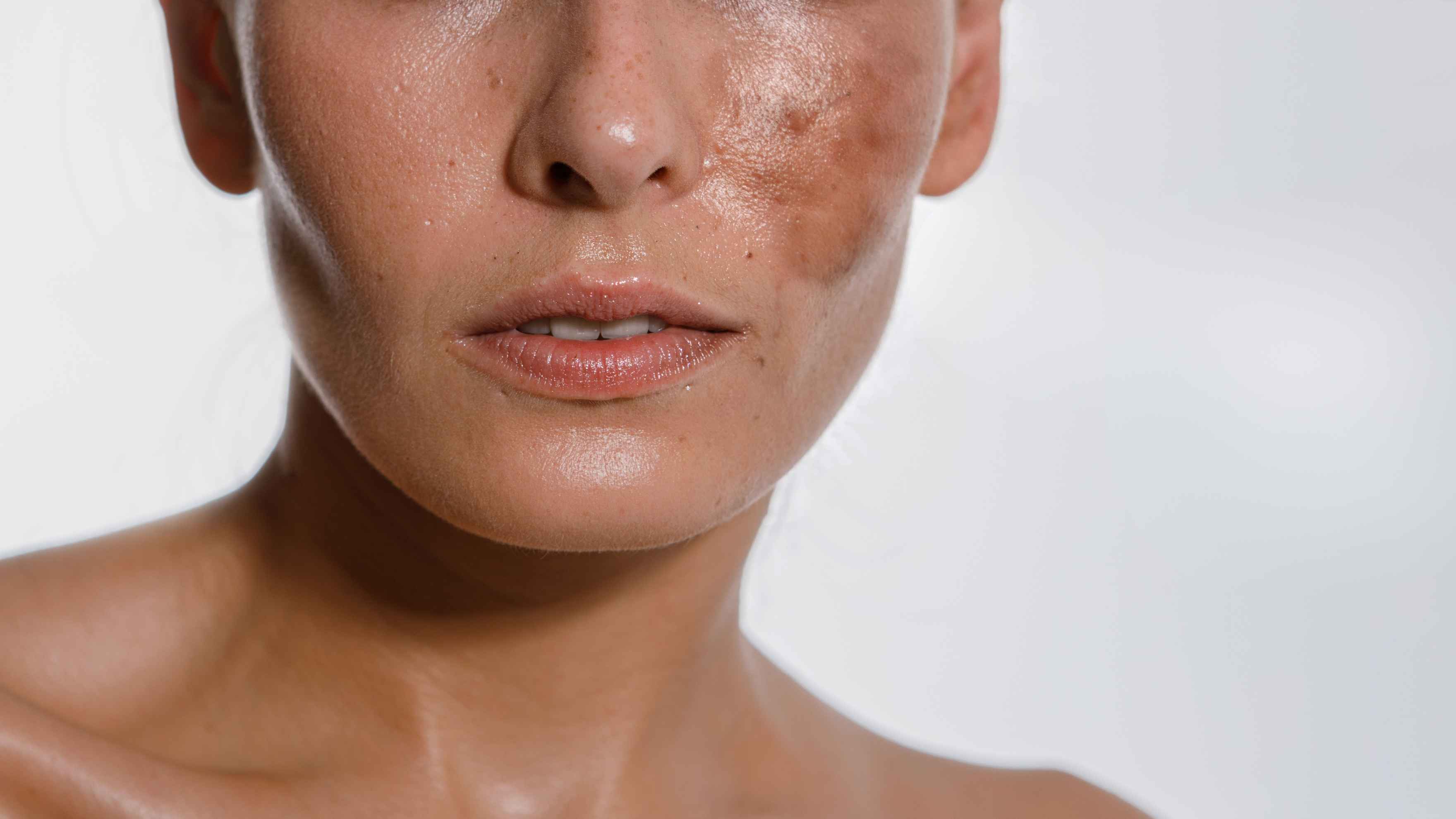 Pigmentation Reduction