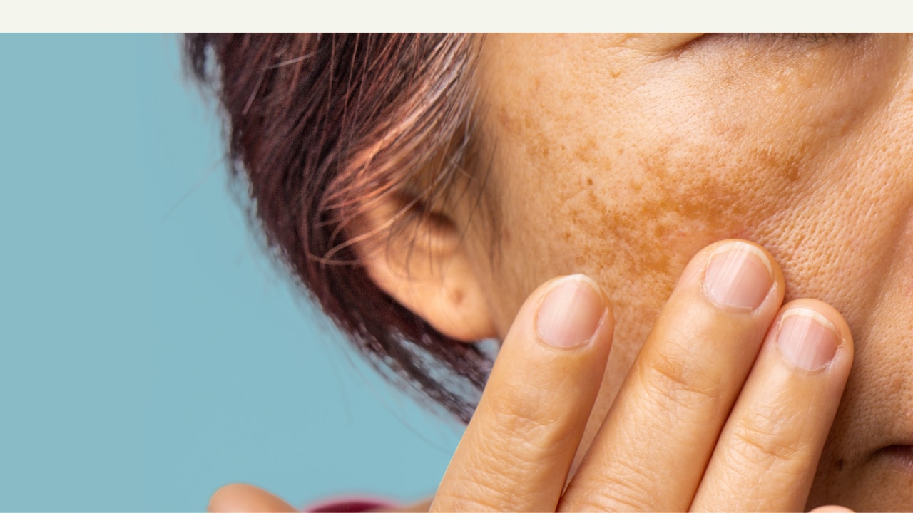 What Causes Dark Spots on the Face?
