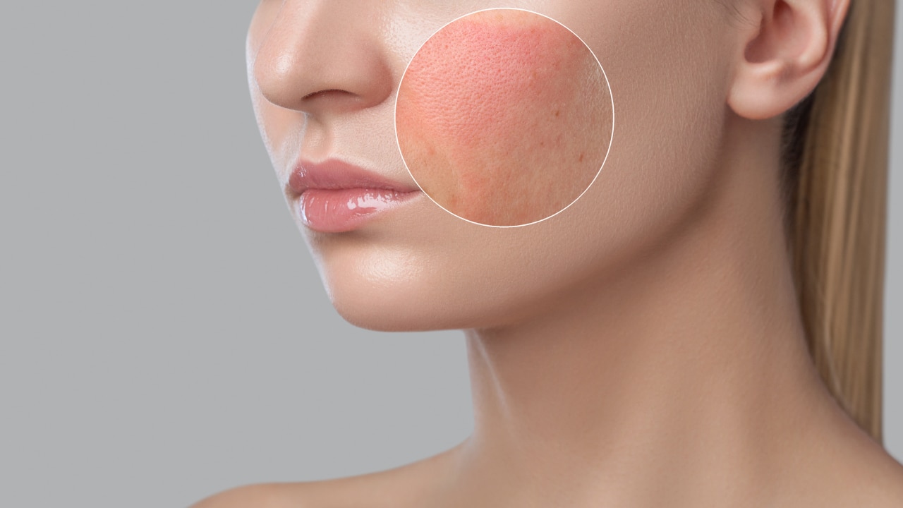 Reduces Inflammation