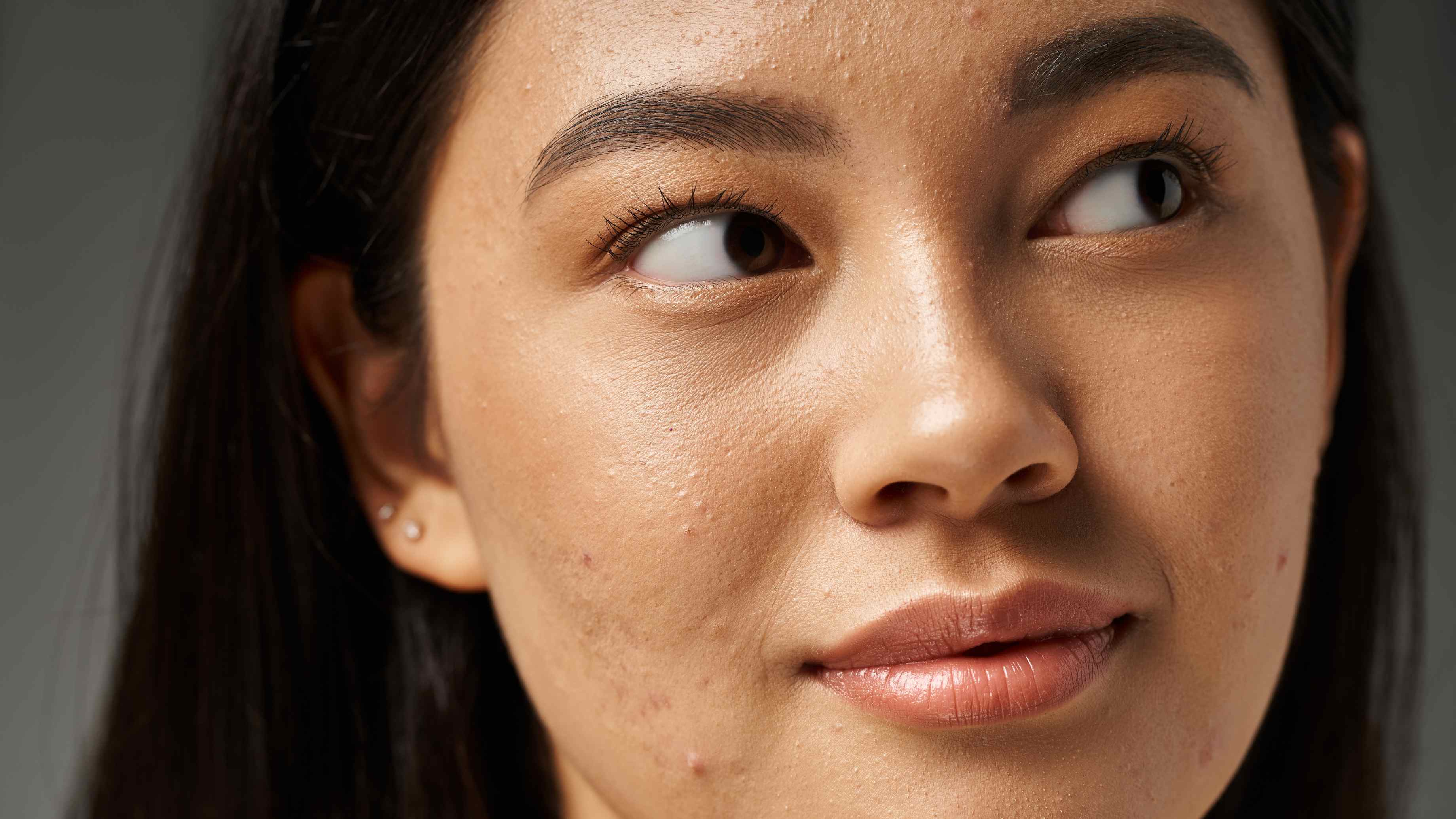 What Causes Pimples and Why Fast Treatment Matters