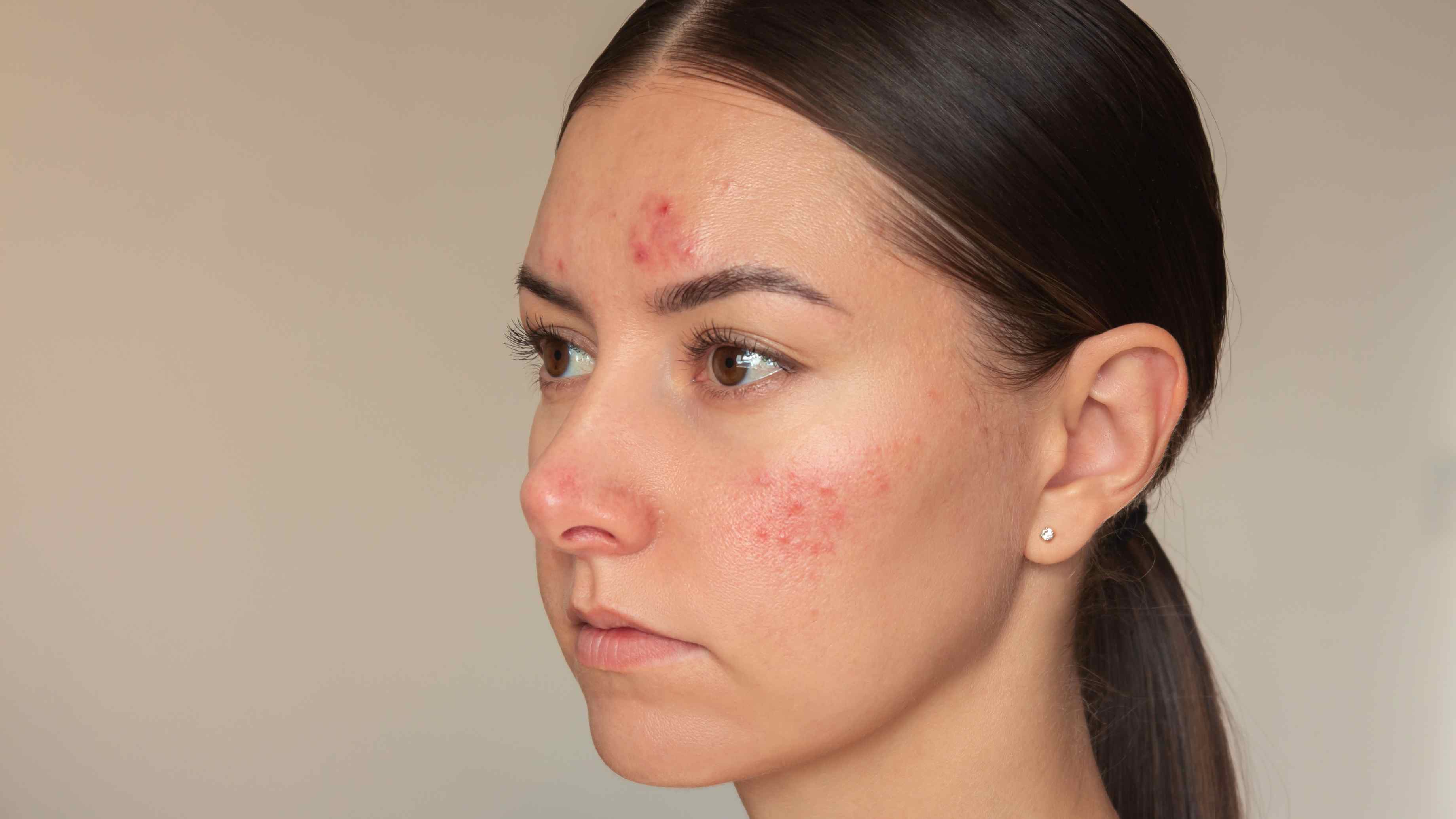 What is Sensitive Skin?