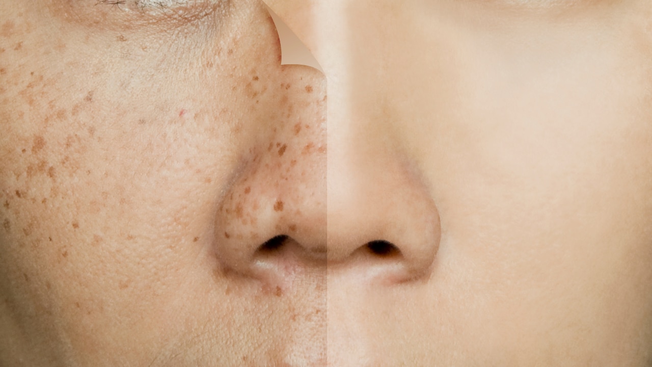 Fades Dark Spots