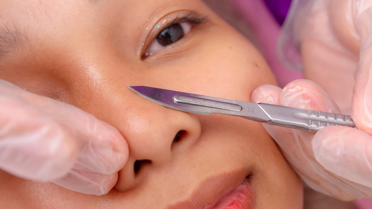 (Optional) Blackhead Extraction (Best Done by a Dermatologist)