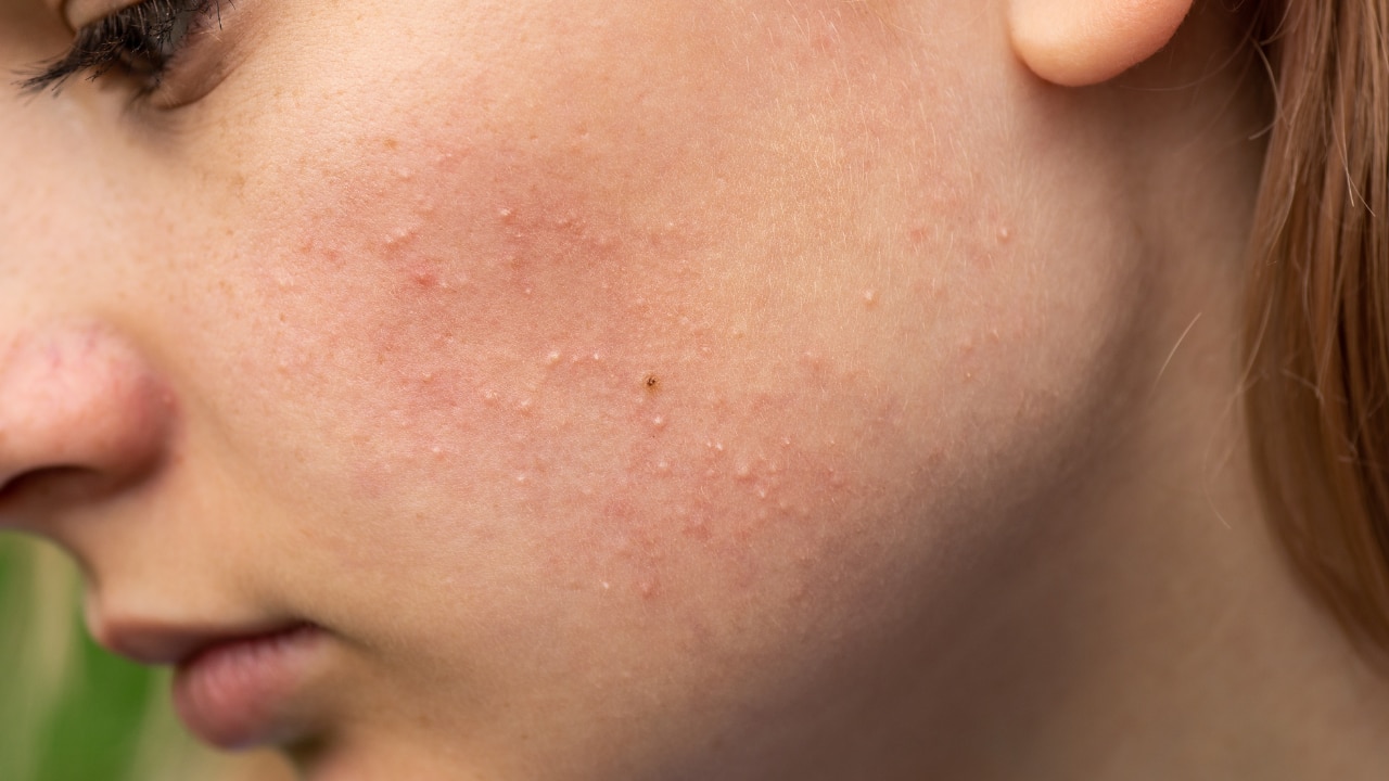 Dead skin buildup