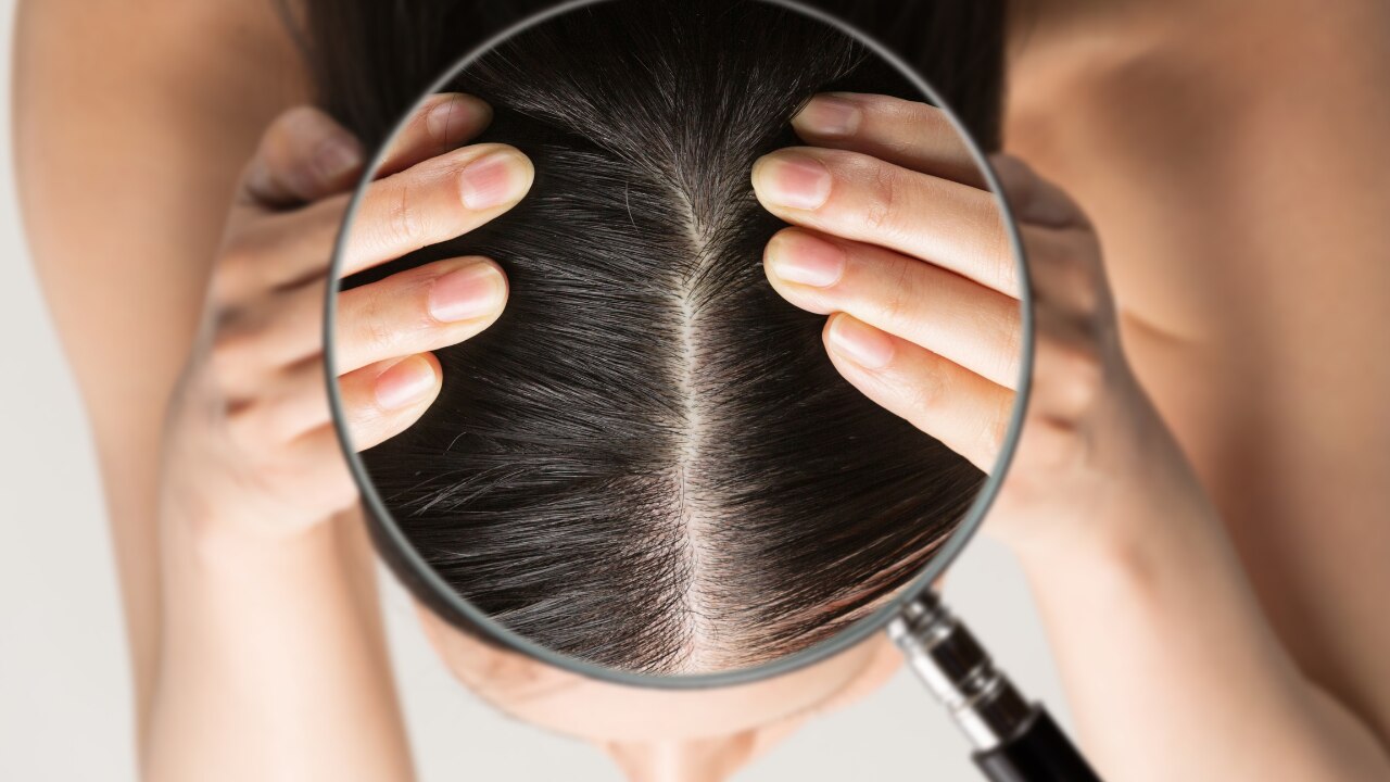 Fights Dandruff & Scalp Infections