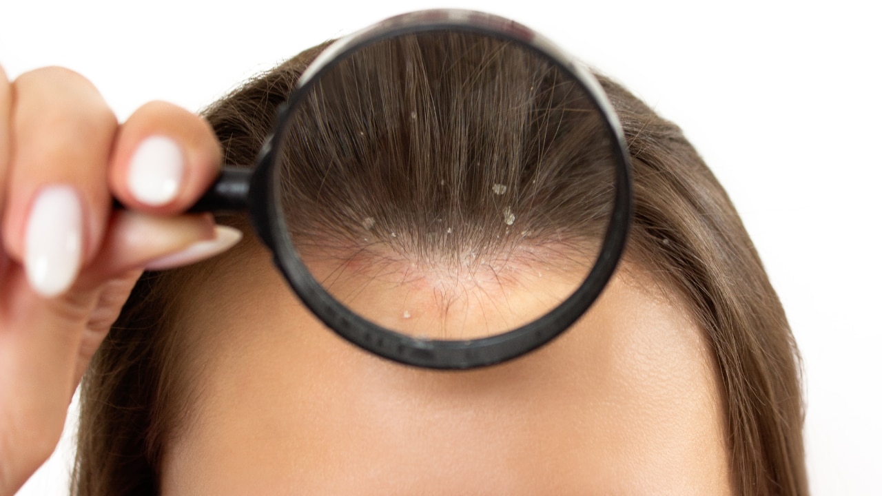 Fights Scalp Infections
