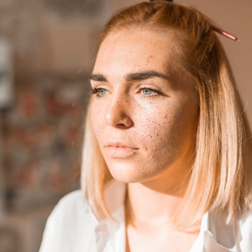 How to Remove Whiteheads: Causes, Home Remedies, Prevention & Skincare Tips