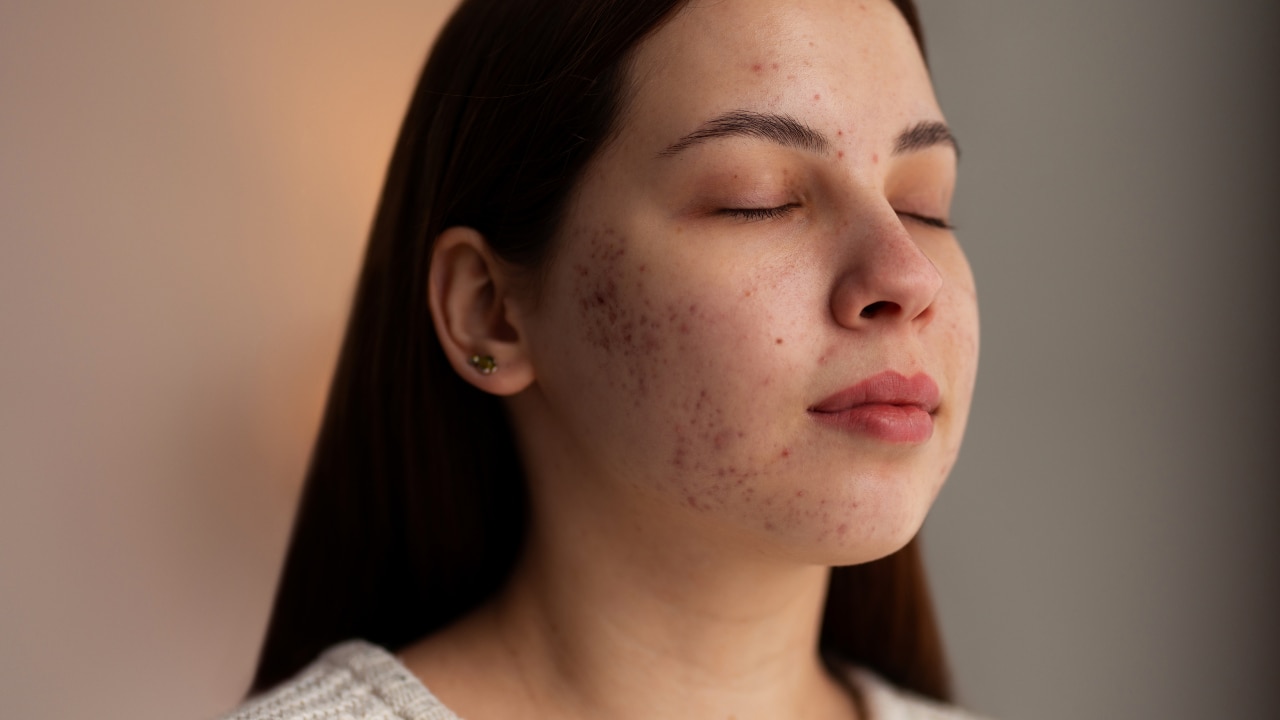 Ideal for Oily and Acne-Prone Skin
